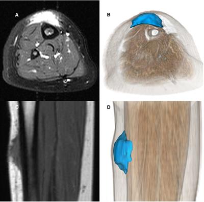 The epifascial cap: A typical imaging sign for subcutaneous granuloma annulare in children